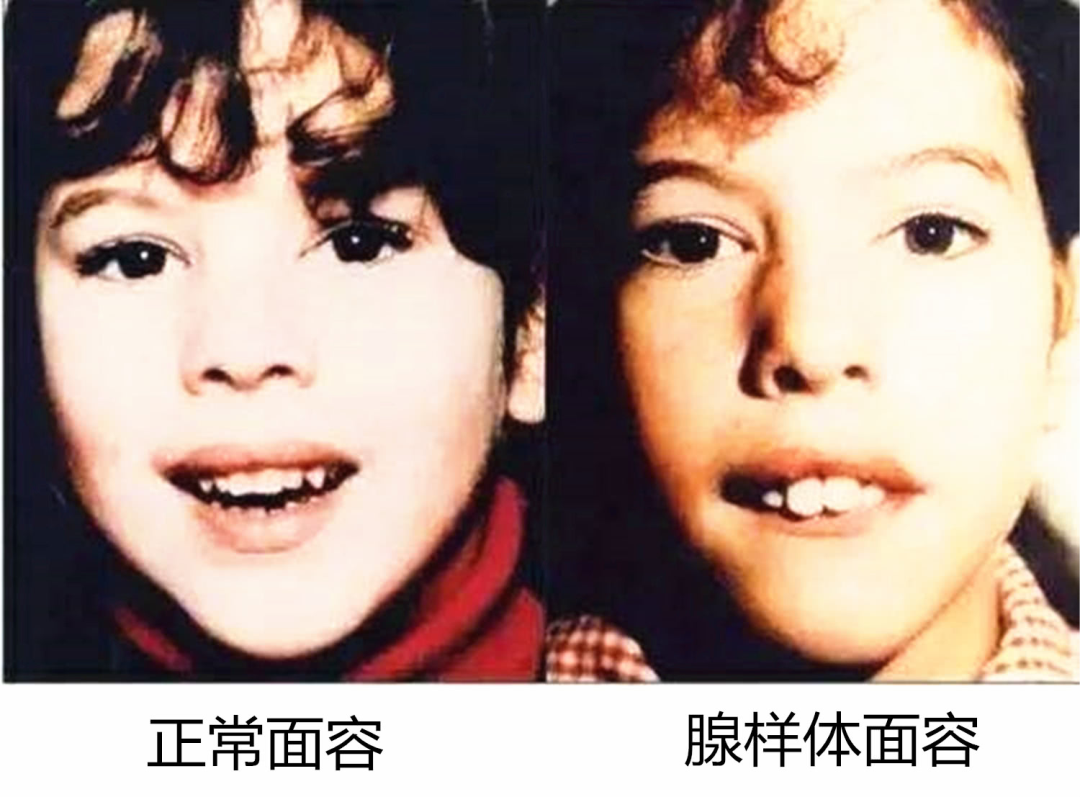 病理性腺样体肥大