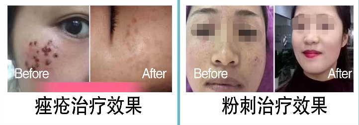 痤疮治疗、粉刺治疗