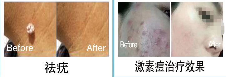 祛疣、激素痘治疗