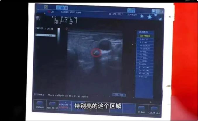 体检报告中的结节、钙化、囊肿都代表什么？一文解读体检报告里的高频词