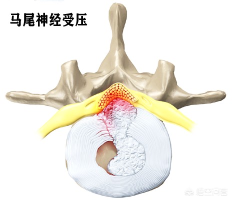 腰椎间盘突出令患者痛苦万分，如何治疗是好？又该如何自我康复呢