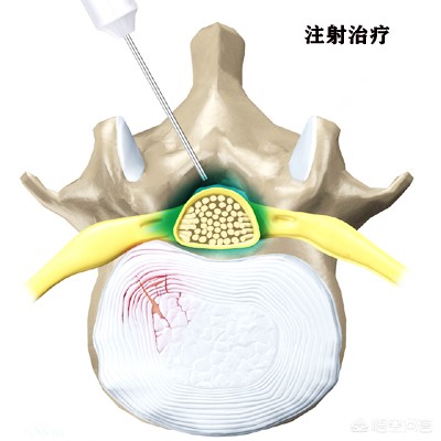 腰椎间盘突出令患者痛苦万分，如何治疗是好？又该如何自我康复呢