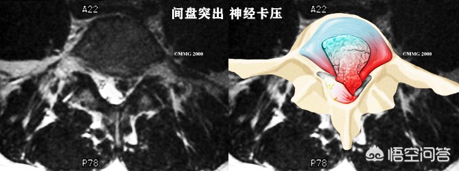 腰椎间盘突出令患者痛苦万分，如何治疗是好？又该如何自我康复呢