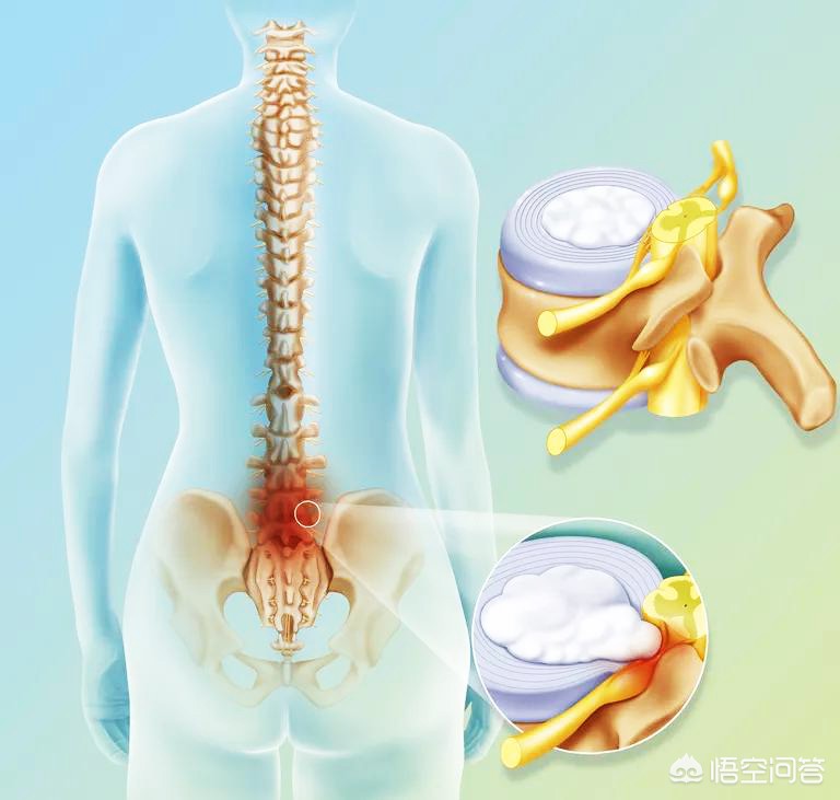 腰椎间盘突出令患者痛苦万分，如何治疗是好？又该如何自我康复呢