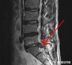 腰椎间盘突出令患者痛苦万分，如何治疗是好？又该如何自我康复呢