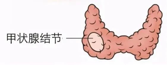 甲状腺结节