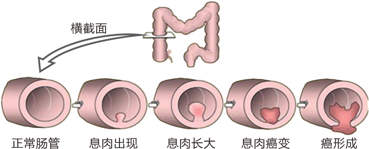 肠镜检查预防结直肠癌